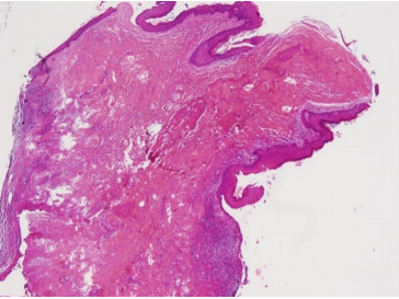 Umbilical Dermoid Cyst: A Rare Case