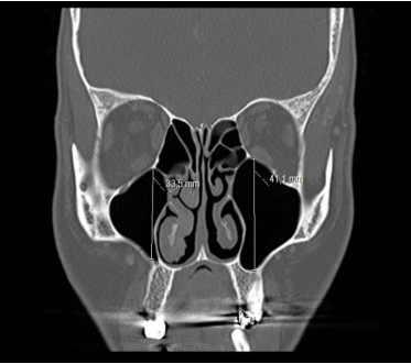 Use of Maxillary and Frontal Sinus Diameters in Sex Determination: Which is Superior?